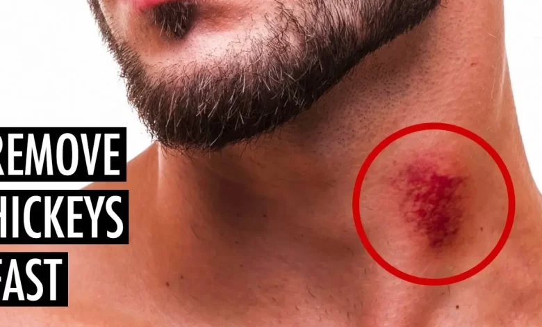 How To Get Rid Of A Hickey