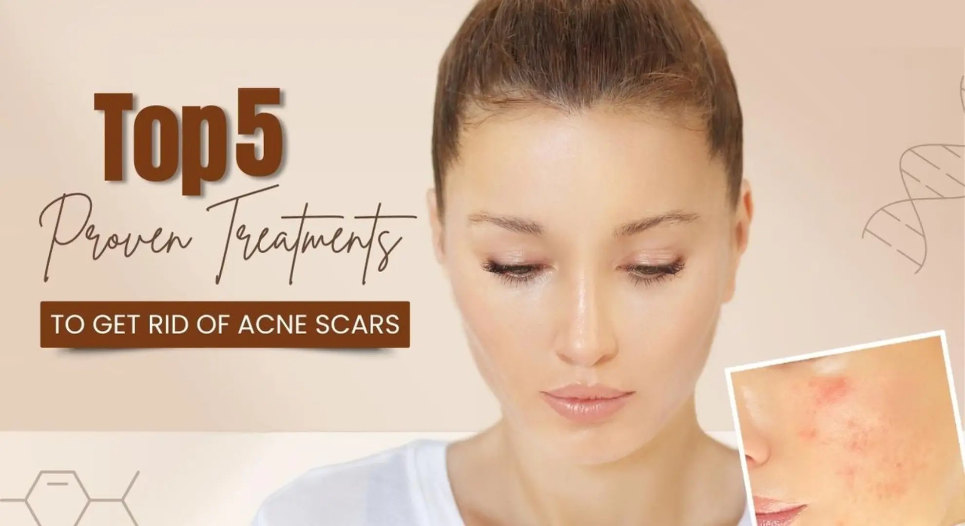 Get Rid of Acne Scars