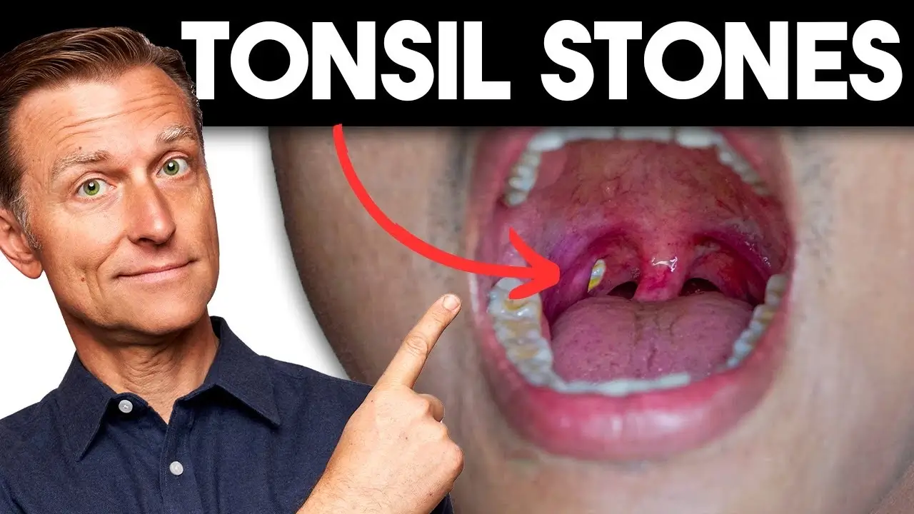 Tonsil Stones