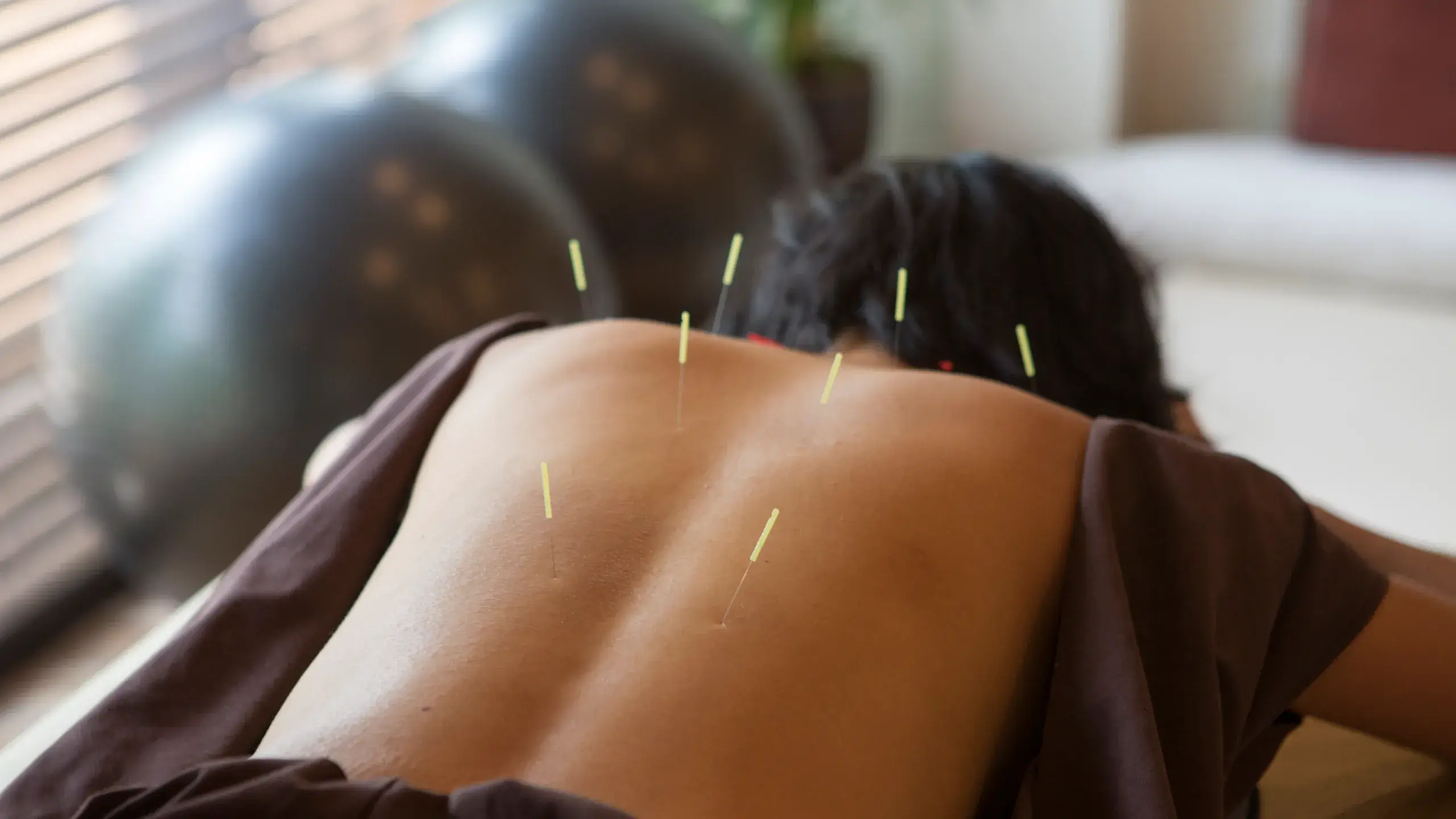 Acupuncture For Weight Loss