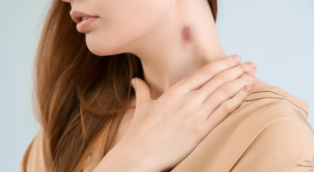 How Long Does A Hickey Last