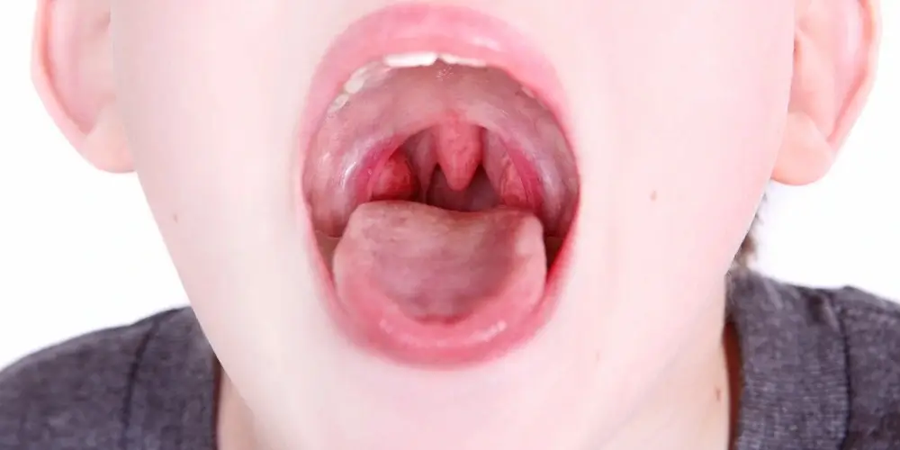 Get Rid Of Swollen Tonsils