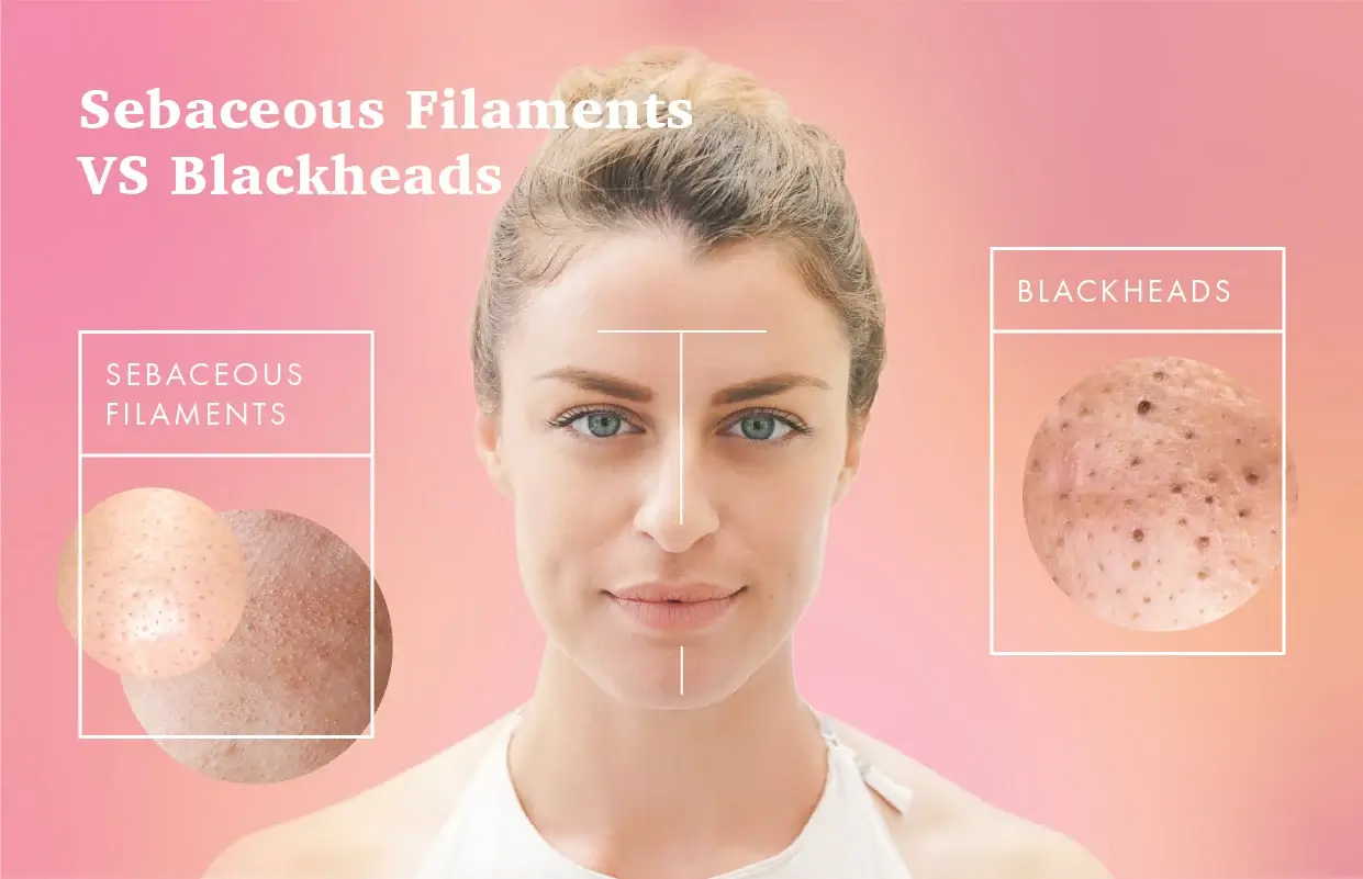 Sebaceous Filaments