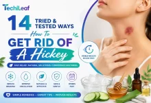 Ways How To Get Rid Of A Hickey