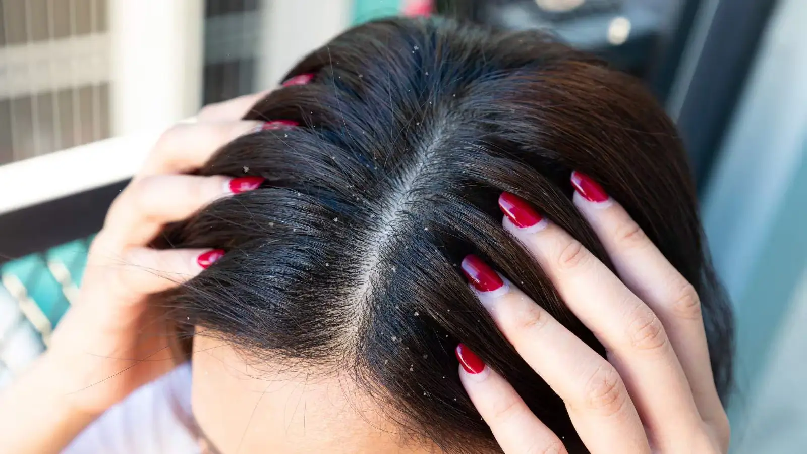 Get Rid Of Dandruff