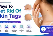 How to Get Rid Of Skin Tags