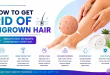 How To Get Rid Of Ingrown Hair Quickly And Safely