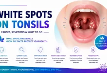 Causes and Symptoms of White Spots on Tonsils