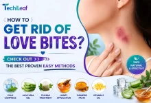 How To Get Rid Of Love Bites