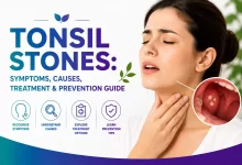 Tonsil Stones Symptoms, Causes, Treatment & Prevention