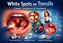 White Spots on Tonsils