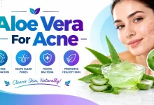 Aloe Vera For Acne