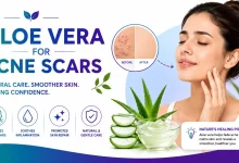 Aloe Vera For Acne Scars