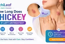 How Long Does A Hickey Last If Left Untreated