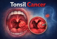 Tonsil Cancer