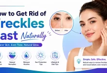 How to Get Rid of Freckles Fast