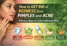 How to Get Rid of Redness from Pimples and Acne