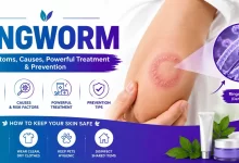 Ringworm